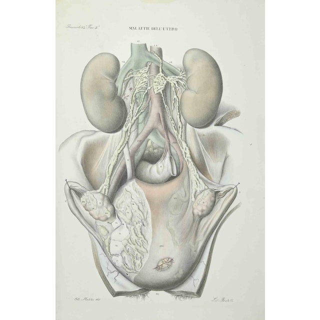 Uterus Diseases is a lithograph hand colored by Ottavio Muzzi for the edition of Antoine Chazal,Human Anatomy, Printers...