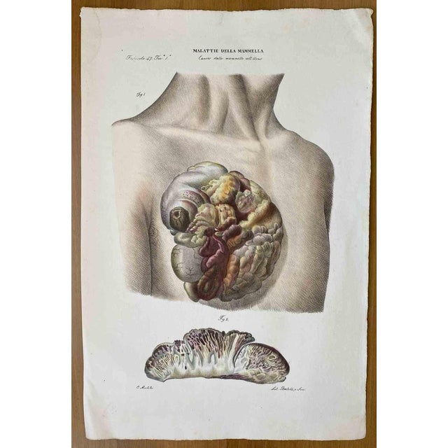 Breast Diseases is a lithograph hand colored by Ottavio Muzzi for the edition of Antoine Chazal, Human Anatomy, Printers...