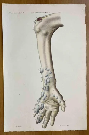 Ottavio Muzzi, Vein Diseases, Lithograph, 1843