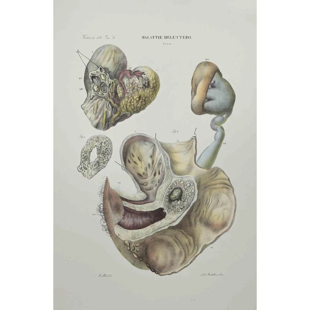 Ottavio Muzzi, Diseases of the Uterus, Lithograph, 1843 For Sale