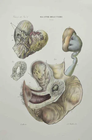 Ottavio Muzzi, Diseases of the Uterus, Lithograph, 1843
