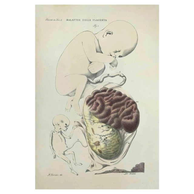 Ottavio Muzzi, Diseases of the Plannta, Lithograph, 1843 For Sale