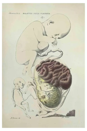 Ottavio Muzzi, Diseases of the Plannta, Lithograph, 1843
