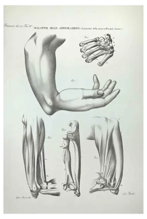 Ottavio Muzzi, Joint Diseases, Lithograph, 1843