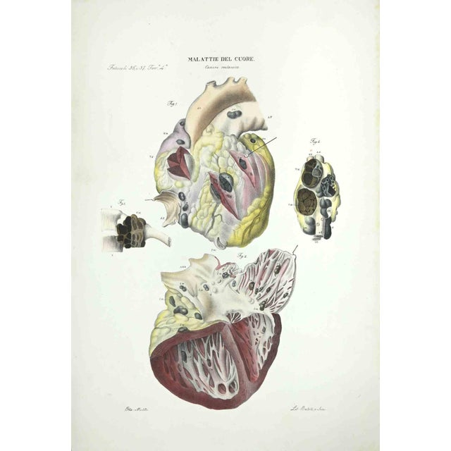 Heart Diseases is a lithograph hand colored by Ottavio Muzzi for the edition of Antoine Chazal, Human Anatomy, Printers...