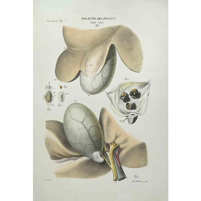 Liver Disease is a lithograph hand colored by Ottavio Muzzi for the edition of Antoine Chazal, Human Anatomy, Printers...
