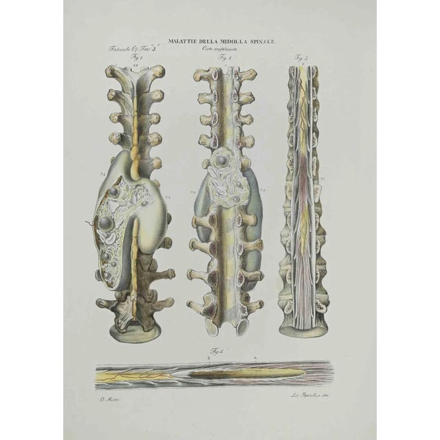 Ottavio Muzzi, Diseases of the Spinal Cord, Lithograph, 1843 For Sale
