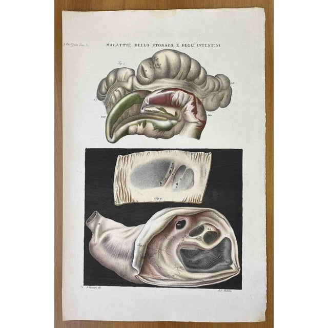 Diseases of the Stomach and Intestines is a lithograph hand colored by Ottavio Muzzi for the edition of Antoine Chazal,...