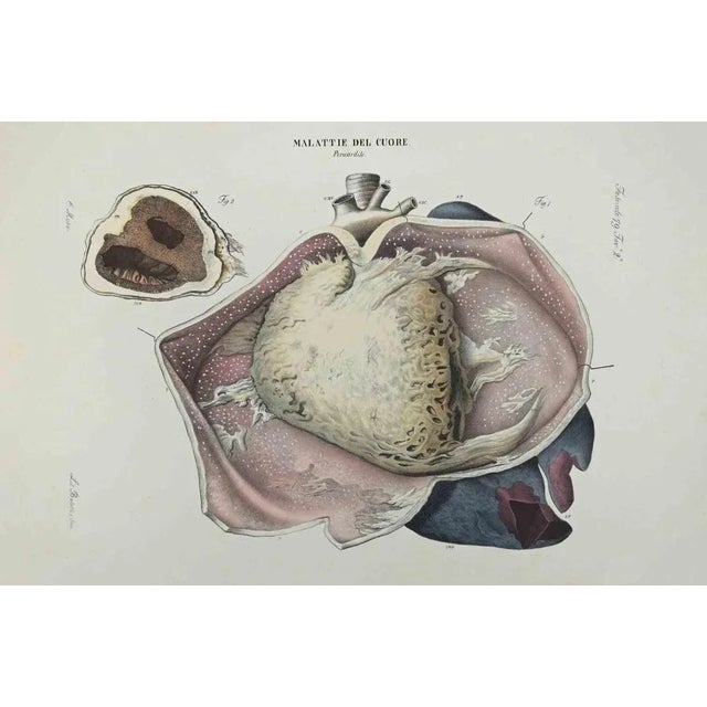 Heart Desease is a lithograph hand colored by Ottavio Muzzi for the edition of Antoine Chazal, Human Deseases, Printers...