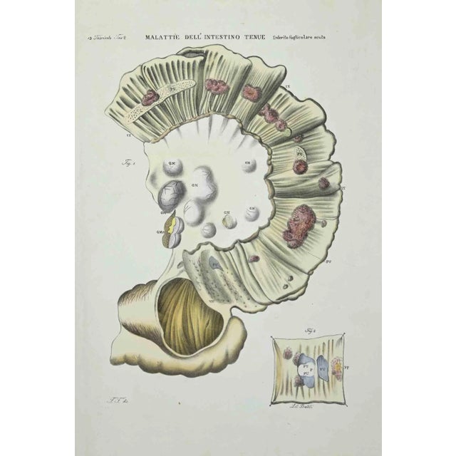 Small Intestine Diseases is a lithograph hand colored by Ottavio Muzzi, for the edition of Antoine Chazal, Human Anatomy,...