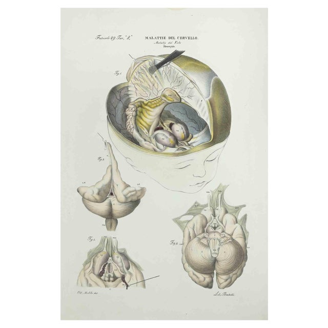 Ottavio Muzzi, Brain Diseases, Lithograph, 1843 For Sale