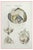 Ottavio Muzzi, Brain Diseases, Lithograph, 1843 For Sale
