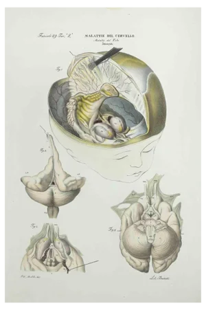 Ottavio Muzzi, Brain Diseases, Lithograph, 1843