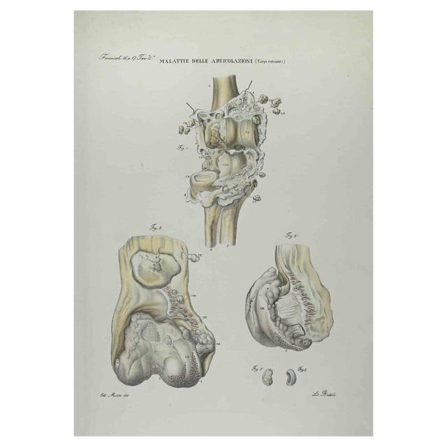 Ottavio Muzzi, Joint Diseases, Lithograph, 1843 For Sale