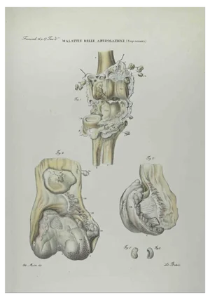 Ottavio Muzzi, Joint Diseases, Lithograph, 1843