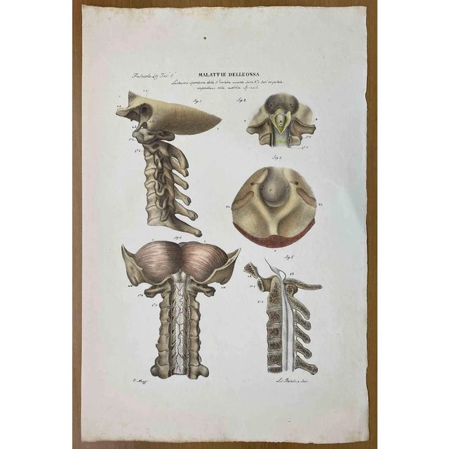 Ottavio Muzzi, Bone Diseases, Lithograph, 1843 For Sale
