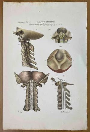 Ottavio Muzzi, Bone Diseases, Lithograph, 1843