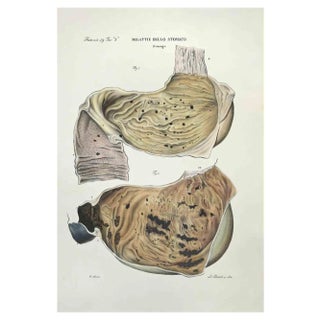 Ottavio Muzzi, Stomach Diseases, Lithograph, 1843 For Sale