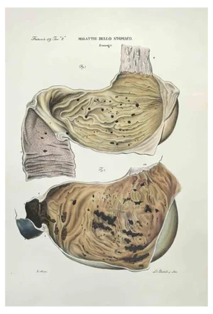Ottavio Muzzi, Stomach Diseases, Lithograph, 1843