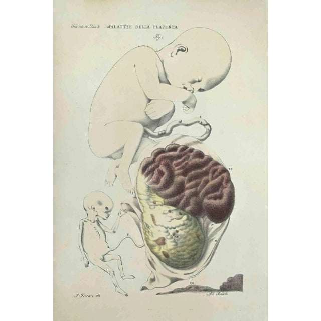 Diseases of the Plannta is a lithograph hand colored by Ottavio Muzzi for the edition of Antoine Chazal, Human Anatomy,...