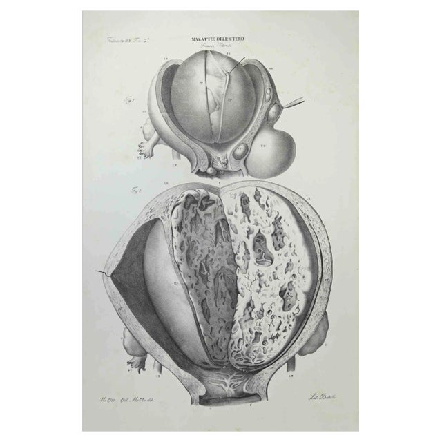 Ottavio Muzzi, Uterus Diseases, Lithograph, 1843 For Sale