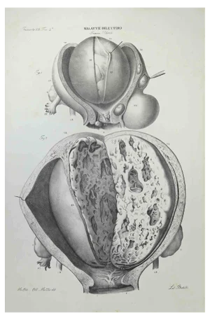 Ottavio Muzzi, Uterus Diseases, Lithograph, 1843
