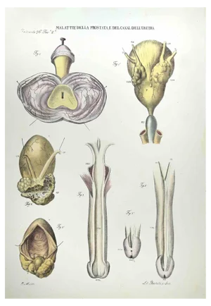 Ottavio Muzzi, Diseases of the Prostate and the Urethra, Lithograph, 1843