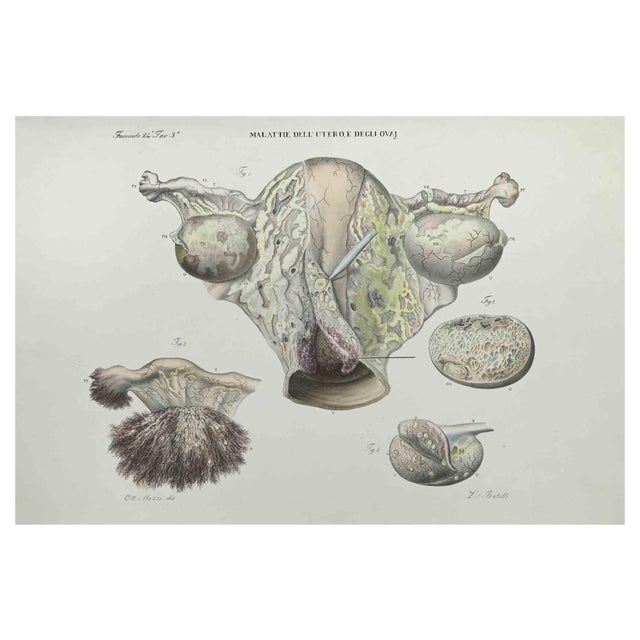 Ottavio Muzzi, Uterus Disease, Lithograph, 1843 For Sale