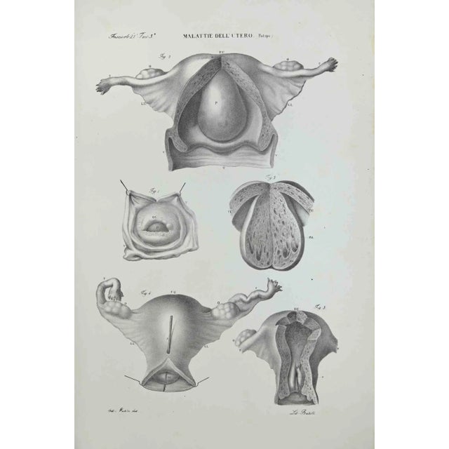 Uterus Diseases is a lithograph hand colored by Ottavio Muzzi for the edition of Antoine Chazal, Human Anatomy, Printers...