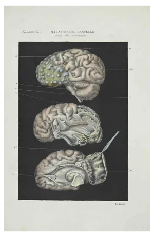 Ottavio Muzzi, Brain Diseases, Lithograph, 1843