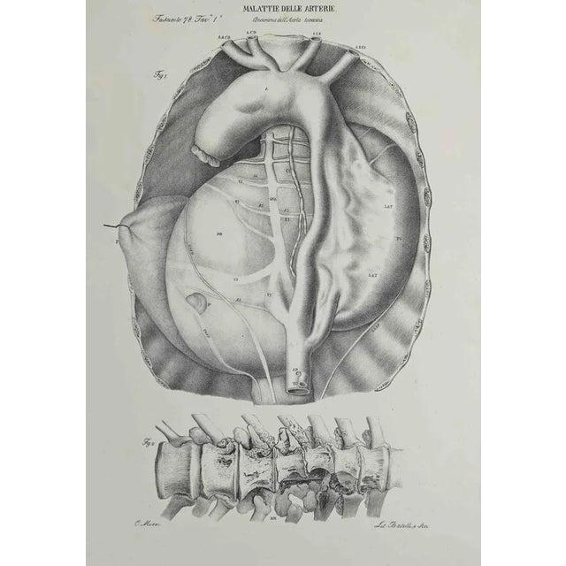 Artery Disease is a lithograph realized by Ottavio Muzzi for the edition of Antoine Chazal, Human Deseases, Printers...