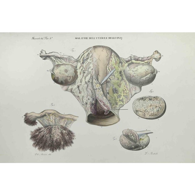 Uterus Diseases is a lithograph hand colored by Ottavio Muzzi for the edition of Antoine Chazal,Human Anatomy, Printers...