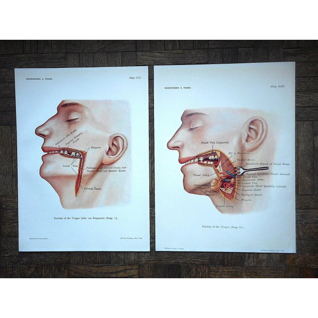 Authentic Antique Anatomical Lithographs-Tongue Surgery-Medical or Macabre?-A Pair For Sale - Image 4 of 4
