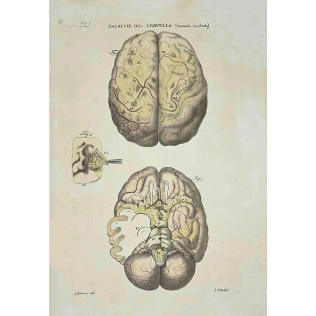 Brain Diseases is a lithograph hand colored by Ottavio Muzzi for the edition of Antoine Chazal, Human Anatomy, Printers...