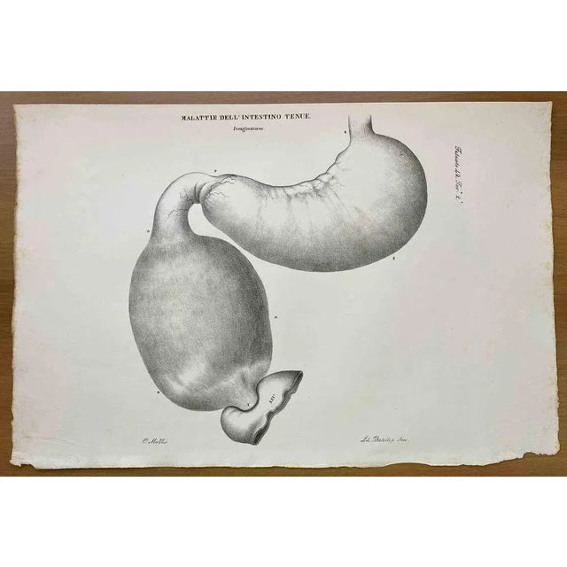 Small Intestine Disease is a lithograph hand colored by Ottavio Muzzi for the edition of Antoine Chazal, Human Anatomy,...