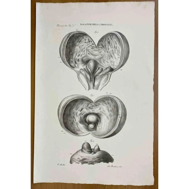 Prostate Diseases is a lithograph hand colored by Ottavio Muzzi for the edition of Antoine Chazal, Human Anatomy, Printers...