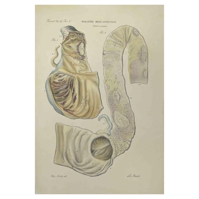Ottavio Muzzi, Bowel Diseases, Lithograph, 1843 For Sale