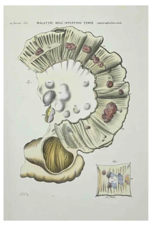 Ottavio Muzzi, Small Intestine Diseases, Lithograph, 1843