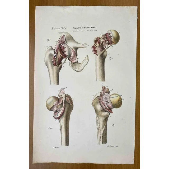 Bone Diseases is a lithograph hand colored by Ottavio Muzzi for the edition of Antoine Chazal, Human Anatomy, Printers...