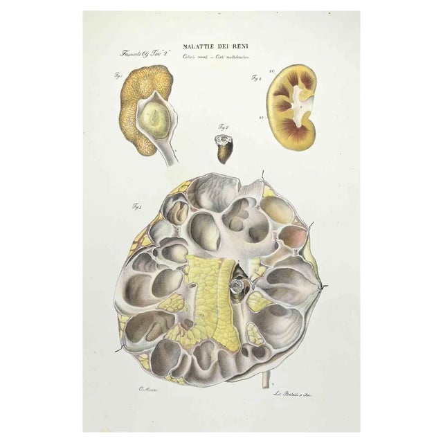 Ottavio Muzzi, Kidney Diseases, Lithograph, 1843 For Sale