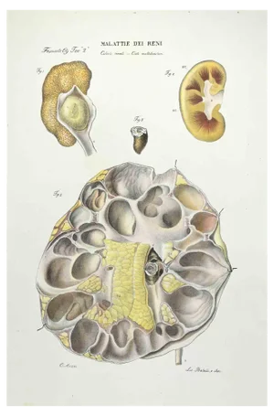 Ottavio Muzzi, Kidney Diseases, Lithograph, 1843