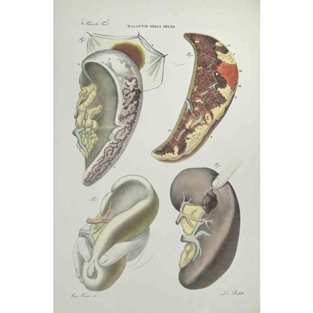 Liver Diseases is a lithograph hand colored by Ottavio Muzzi for the edition of Antoine Chazal, Human Anatomy, Printers...