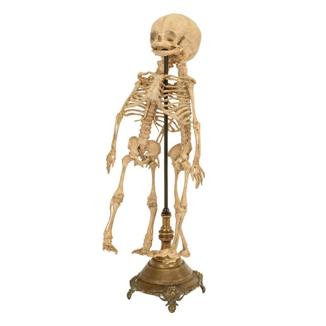 Antique 19thC Anatomical Conjoined Syncephalus Twins Skeleton Medical Model 1860 For Sale - Image 14 of 17