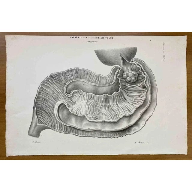 Small Intestine Disease is a lithograph hand colored by Ottavio Muzzi for the edition of Antoine Chazal, Human Anatomy,...