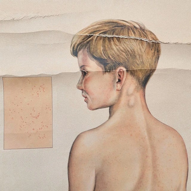 1930s Vintage Training Poster with Childhood Illnesses, 1930-1940 For Sale - Image 5 of 7