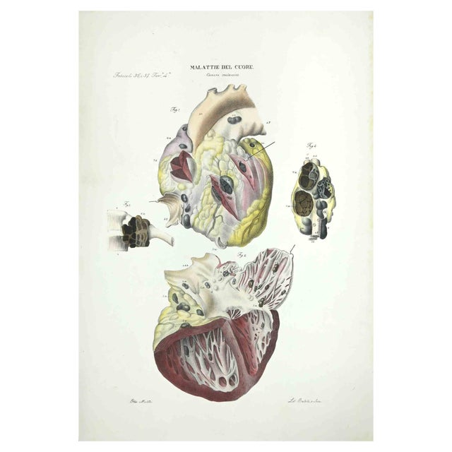 Ottavio Muzzi, Heart Diseases, Lithograph, 1843 For Sale