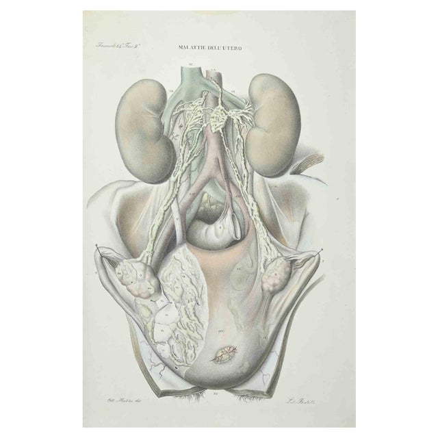 Ottavio Muzzi, Uterus Diseases, Lithograph, 1843 For Sale