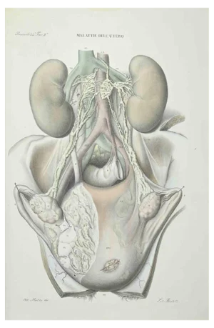 Ottavio Muzzi, Uterus Diseases, Lithograph, 1843