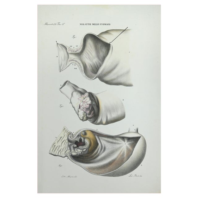 Ottavio Muzzi, Stomach Diseases, Lithograph, 1843 For Sale