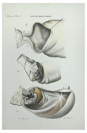 Ottavio Muzzi, Stomach Diseases, Lithograph, 1843